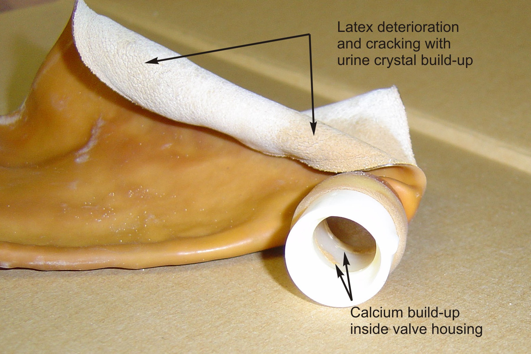 Leg Bag Deterioration
